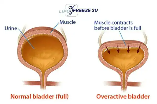 diagram of overactive bladder treatment Buckingham