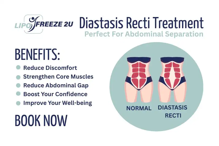 How Long Will It Take to See Improvements in Diastasis Recti Buckingham