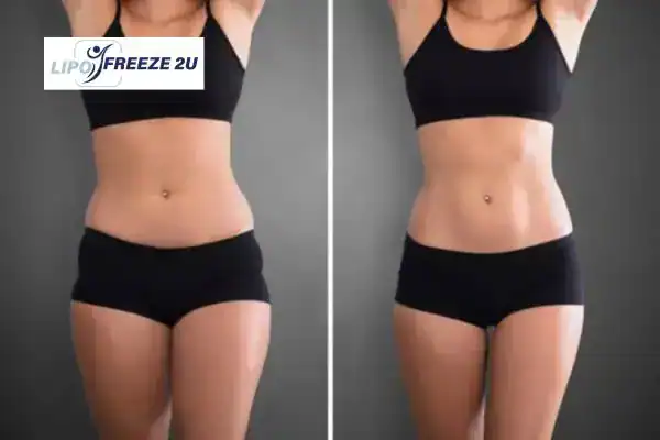 How Can LIPO FREEZE 2U Support Your Post-Pregnancy Body Recovery Buckingham?
