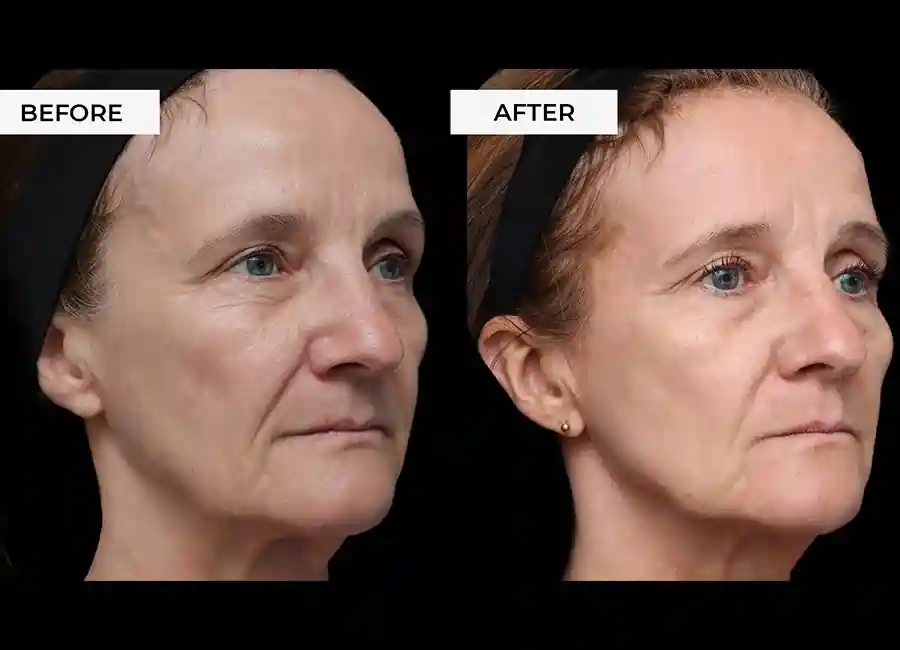 How Many RF Microneedling Sessions Will You Need to See a Difference Buckingham?