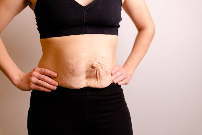 Is Surgery Really the Only Way to Repair Diastasis Recti Buckingham?