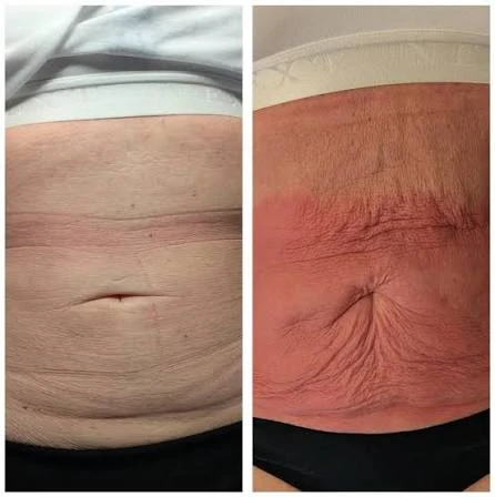 How Does RF Microneedling Improve Crepey, Thin and Uneven Skin Texture Buckingham?