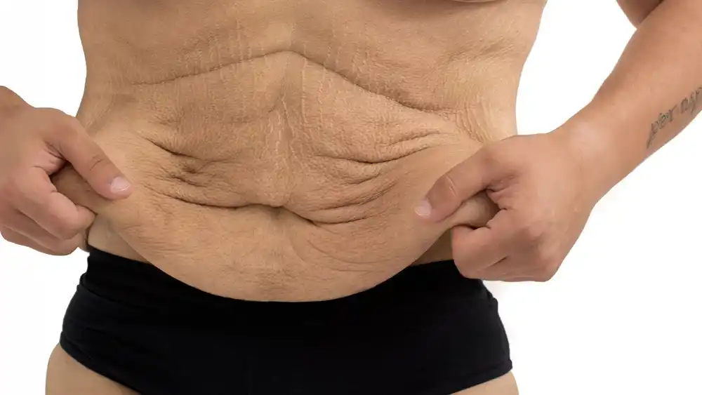 RF Microneedling for Loose Skin: How Can It Help Tighten and Reshape the Skin Buckingham?
